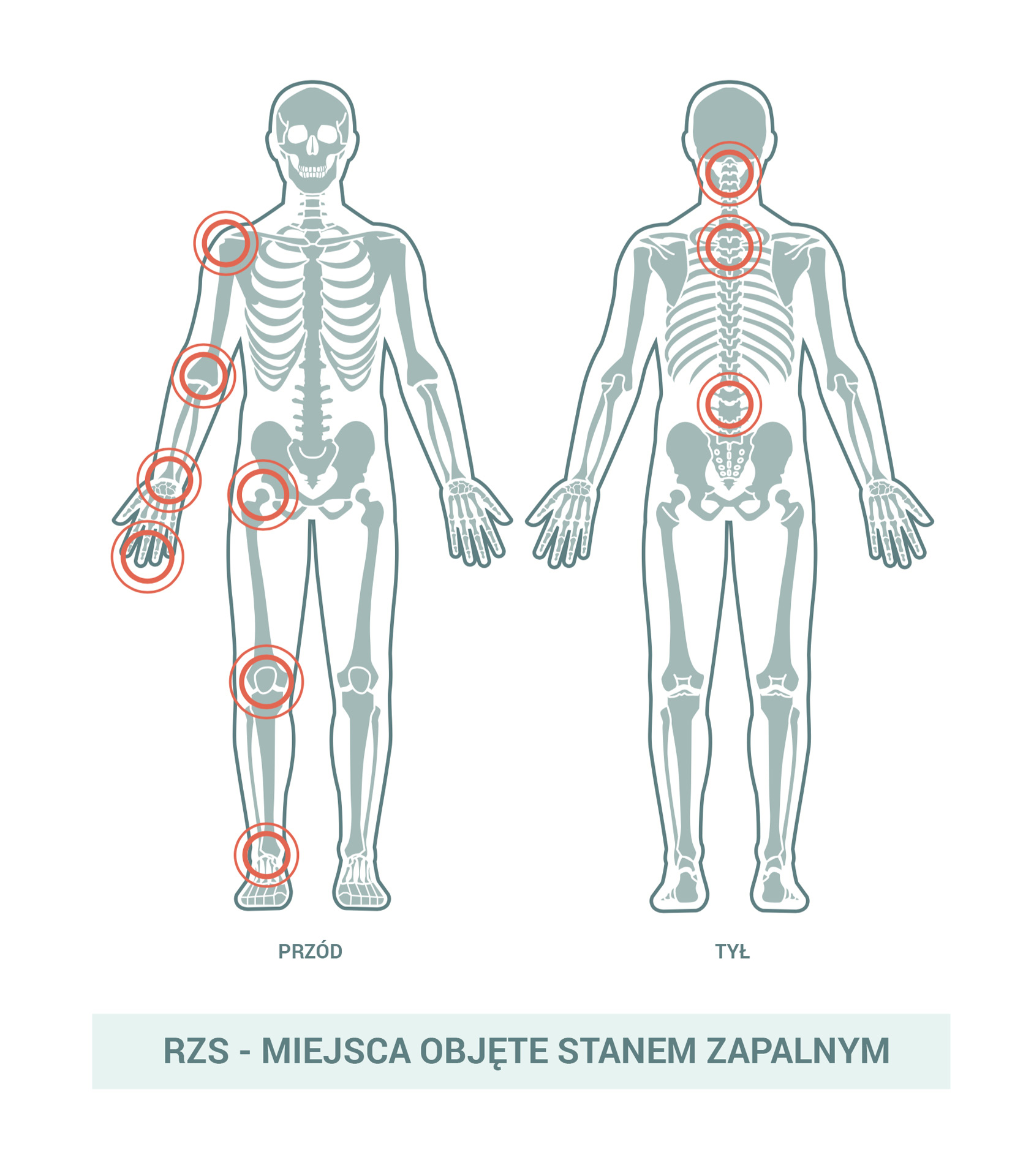 RZS - miejsca objęte stanem zapalnym